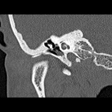 File:Adhesive chronic otitis media (Radiopaedia 14270-14148 Coronal bone window - right 7).jpg