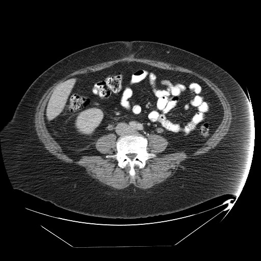 Adrenal angiosarcoma (Radiopaedia 81081-94671 Axial C+ portal venous phase 50).jpg