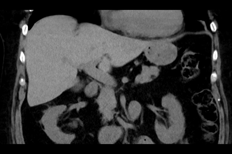 File:Adrenal cortical carcinoma (Radiopaedia 64017-72769 Coronal non-contrast 25).jpg