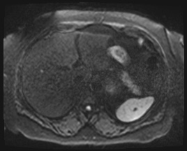 Adrenal cortical carcinoma (Radiopaedia 64017-72770 Axial DWI 51).jpg