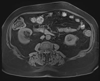 Adrenal cortical carcinoma (Radiopaedia 64017-72770 Axial T1 fat sat 54).jpg