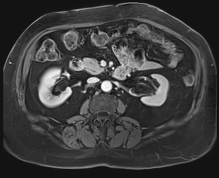 Adrenal cortical carcinoma (Radiopaedia 64017-72770 J 46).jpg