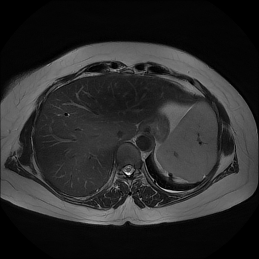 File:Adrenal cortical carcinoma (Radiopaedia 70906-81116 Axial T2 5).jpg