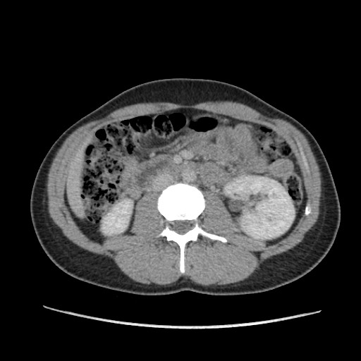Adrenal cyst (Radiopaedia 64869-73813 Axial C+ portal venous phase 37).jpg