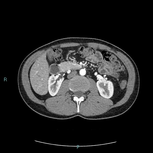 Adrenal cystic lymphangioma (Radiopaedia 83161-97534 Axial C+ arterial phase 41).jpg