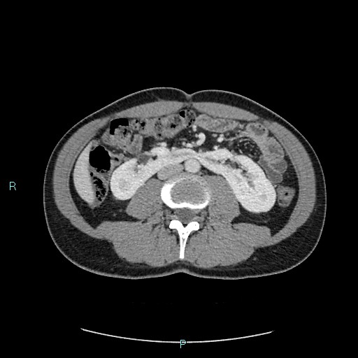 Adrenal cystic lymphangioma (Radiopaedia 83161-97534 Axial C+ portal venous phase 50).jpg