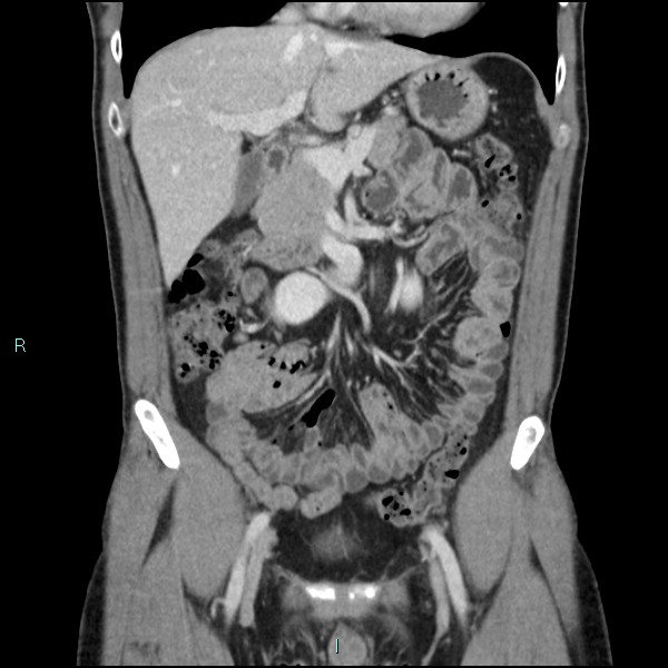 File:Adrenal cystic lymphangioma (Radiopaedia 83161-97534 Coronal C+ portal venous phase 28).jpg