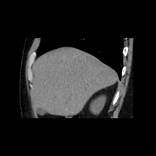 Adrenal gland trauma (Radiopaedia 81351-95079 Sagittal non-contrast 19).jpg
