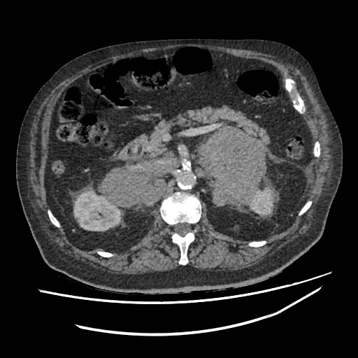Adrenal lymphoma (Radiopaedia 84145-99415 Axial C+ portal venous phase 44).jpg