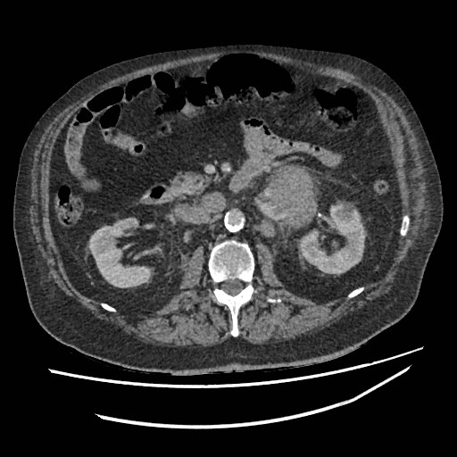 Adrenal lymphoma (Radiopaedia 84145-99415 Axial C+ portal venous phase 56).jpg