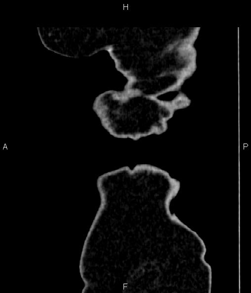 Adrenal myelolipoma (Radiopaedia 82742-96986 Sagittal renal cortical phase 111).jpg