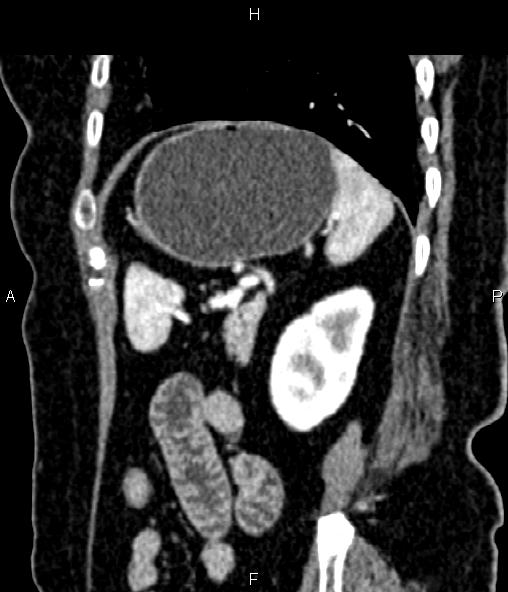 Adrenal myelolipoma (Radiopaedia 82742-96986 Sagittal renal cortical phase 83).jpg