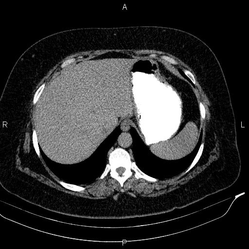 File:Adrenal myelolipoma (Radiopaedia 84319-99617 Axial With oral contrast 37).jpg