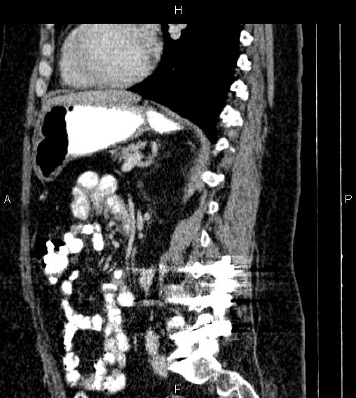 Adrenal myelolipoma (Radiopaedia 84319-99617 Sagittal renal cortical phase 58).jpg