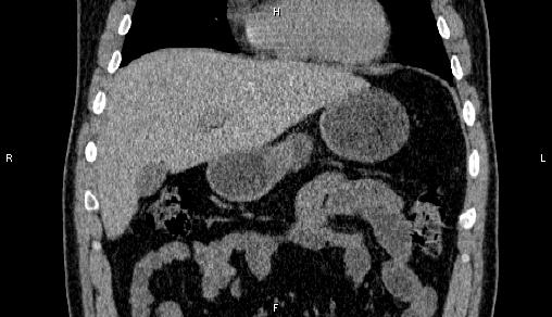 Adrenal myelolipoma (Radiopaedia 84321-99619 Coronal non-contrast 24).jpg