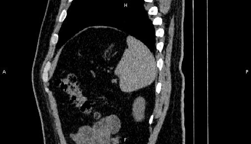 Adrenal myelolipoma (Radiopaedia 84321-99619 Sagittal non-contrast 91).jpg