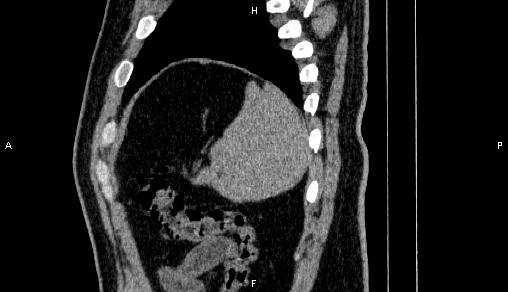 Adrenal myelolipoma (Radiopaedia 84321-99619 Sagittal non-contrast 95).jpg