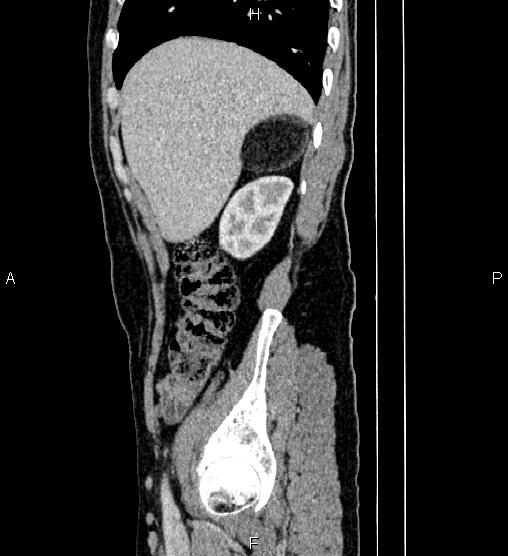 Adrenal myelolipoma (Radiopaedia 87794-104246 Sagittal renal cortical phase 20).jpg