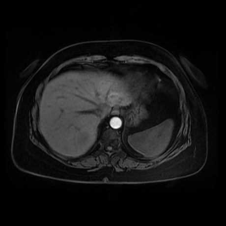 Adrenal myelolipoma - MRI (Radiopaedia 83249-97646 Axial T1 fat sat 6).jpg