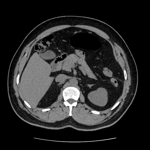 Adrenal myelolipoma and beaver tail liver (Radiopaedia 86201-102193 Axial non-contrast 164).jpg
