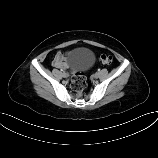 File:Adrenocortical carcinoma (Radiopaedia 87281-103569 Axial C+ portal venous phase 69).jpg