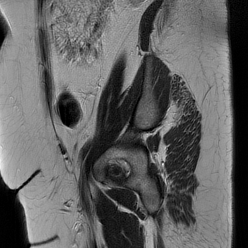 File:Adult granulosa cell tumor of the ovary (Radiopaedia 64991-73953 Sagittal T2 25).jpg