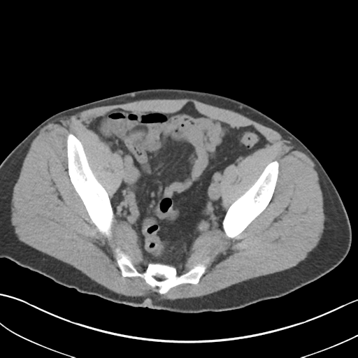 File:Adult polycystic kidney disease (Radiopaedia 47866-52626 Axial non-contrast 69).png