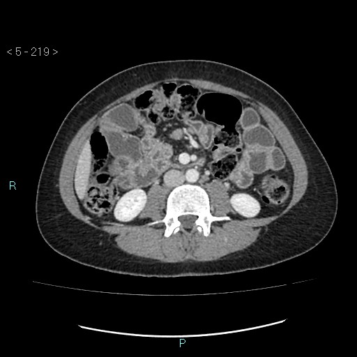 Adult transient intestinal intussusception (Radiopaedia 34853-36310 Axial C+ portal venous phase 42).jpg