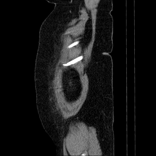 Afferent loop syndrome - secondary to incarcerated trocar site hernia (Radiopaedia 82959-97305 Sagittal C+ portal venous phase 145).jpg