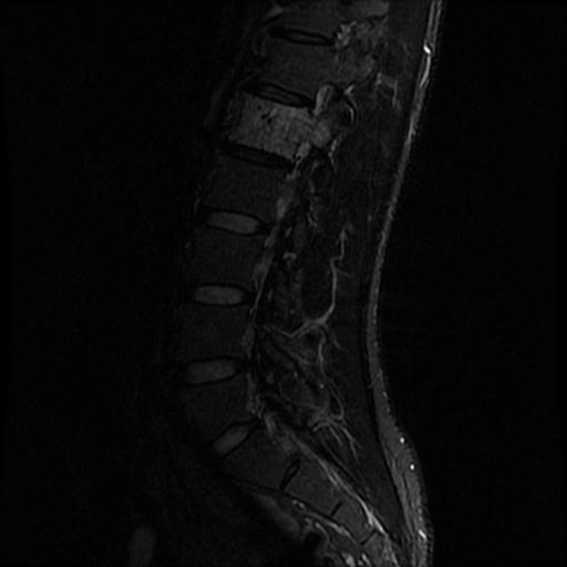 File:Aggressive vertebral hemangioma with pathological fracture (Radiopaedia 69528-79411 Sagittal STIR 3).jpg