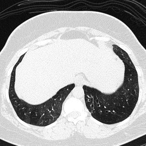 Air trapping in small airway disease (Radiopaedia 61685-69694 Axial lung window 162).jpg