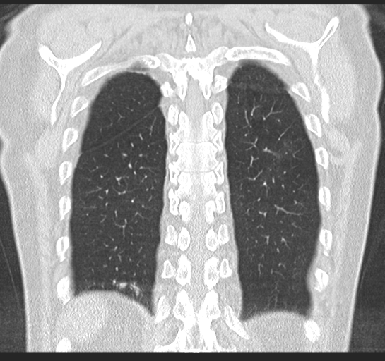 Allergic bronchopulmonary aspergillosis (Radiopaedia 44760-48571 Coronal lung window 48).png
