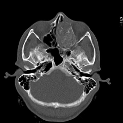File:Allergic fungal sinusitis (Radiopaedia 29086-29455 Axial bone window 9).jpg
