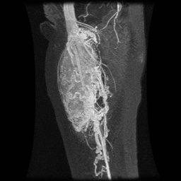 Alveolar soft part sarcoma (Radiopaedia 64501-73678 D 1).jpg
