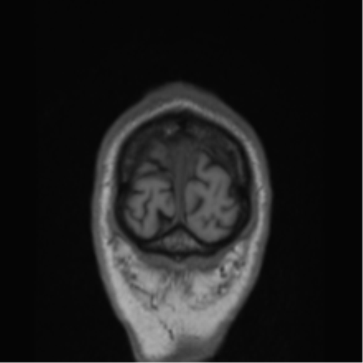 File:Alzheimer's disease- with Gerstmann syndrome and dressing apraxia (Radiopaedia 54882-61150 Coronal T1 4).png