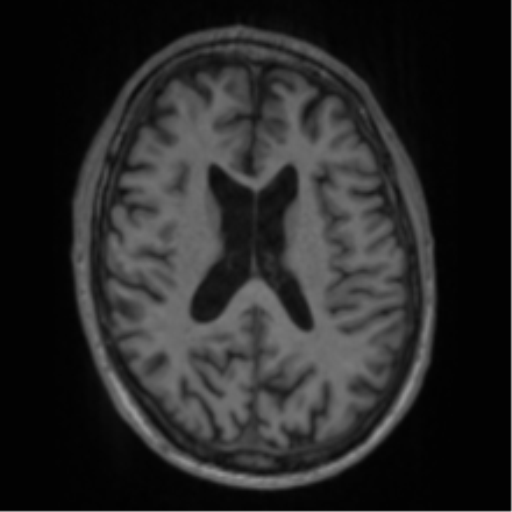 Alzheimer's disease- with apraxia (Radiopaedia 54763-61011 Axial T1 45).png