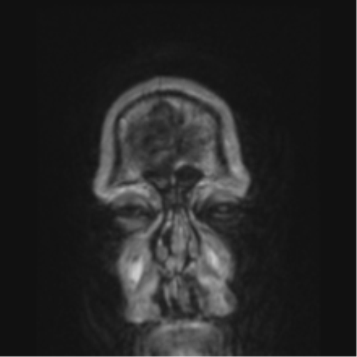 File:Alzheimer's disease- with apraxia (Radiopaedia 54763-61011 Coronal T1 90).png