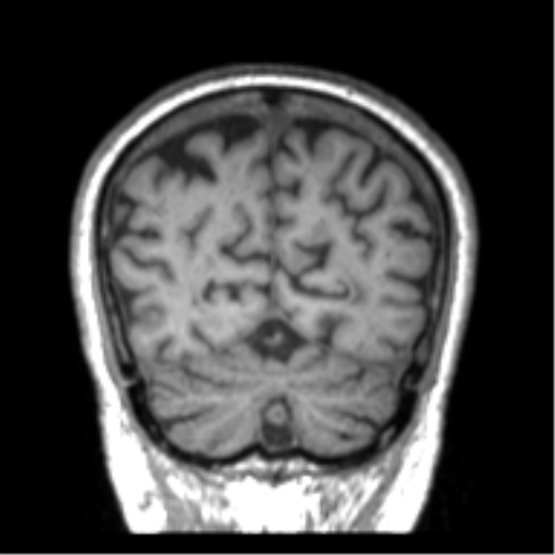 Alzheimer disease and cerebral amyloid angiopathy (Radiopaedia 64234-73011 Coronal T1 6).png