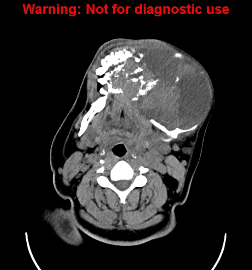 File:Ameloblastoma (Radiopaedia 33126-34164 A 13).jpg