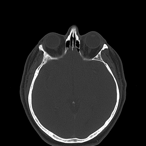 Ameloblastoma (Radiopaedia 38520-40623 Axial bone window 1).png