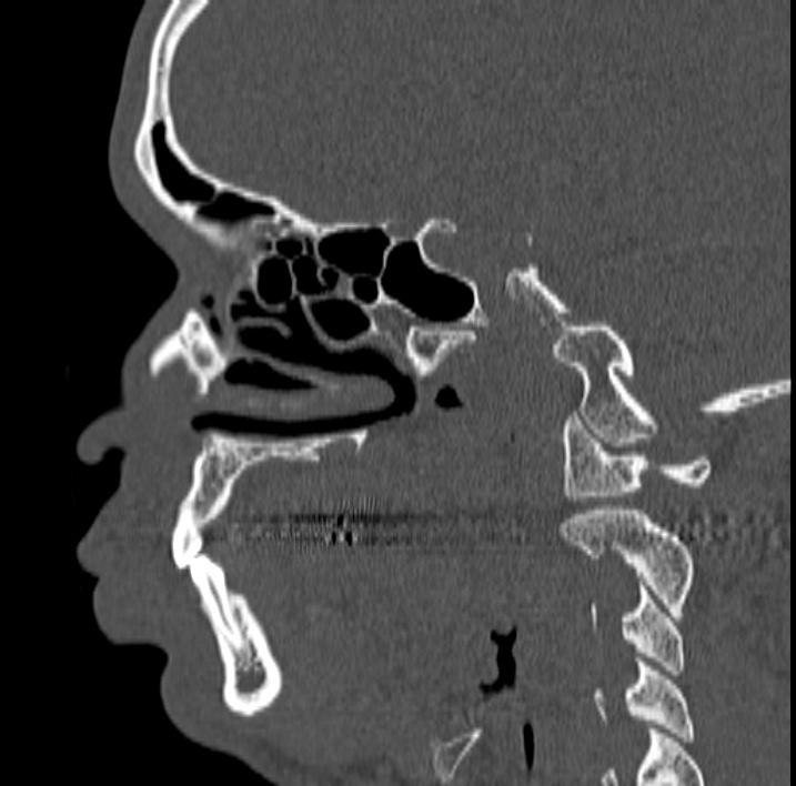 Ameloblastoma (Radiopaedia 77750-89997 Sagittal bone window 5).jpg