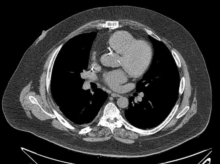 Amiodarone lung (Radiopaedia 62514-70769 Axial non-contrast 46).jpg