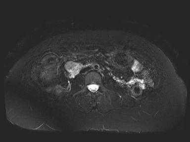 Ampullary adenocarcinoma (Radiopaedia 54765-61014 Axial T2 space-FS 51).jpg