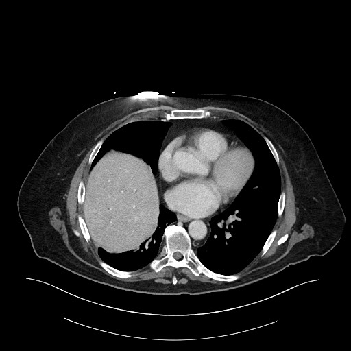 File:Ampullary adenocarcinoma (Radiopaedia 59373-66734 C 13).jpg
