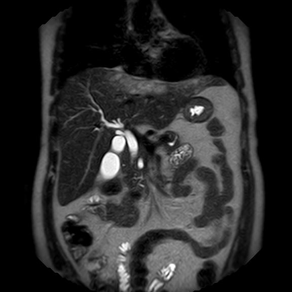 File:Ampullary tumor (Radiopaedia 27294-27479 Coronal T2 10).jpg