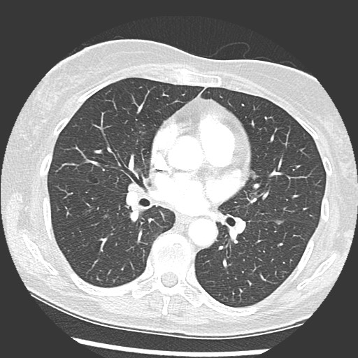 Amyloidosis - bronchial and diffuse nodular pulmonary involvement (Radiopaedia 60156-67745 Axial lung window 42).jpg