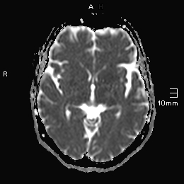 File:Amyotrophic lateral sclerosis (Radiopaedia 70821-81017 Axial ADC 11).jpg