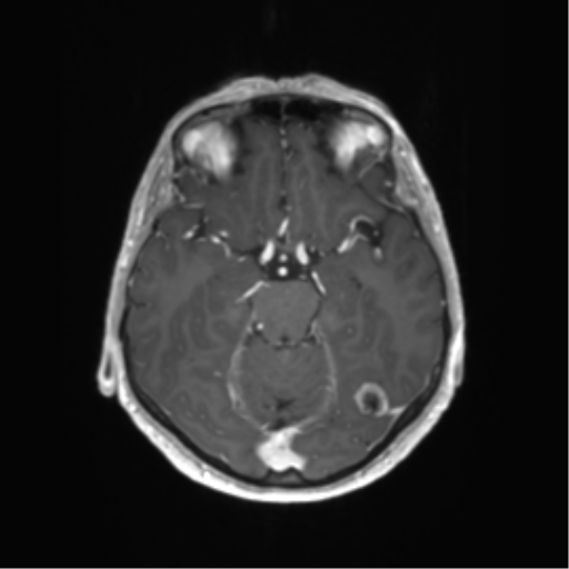 File:Anaplastic astrocytoma (Radiopaedia 86943-103160 Axial T1 C+ 11).png