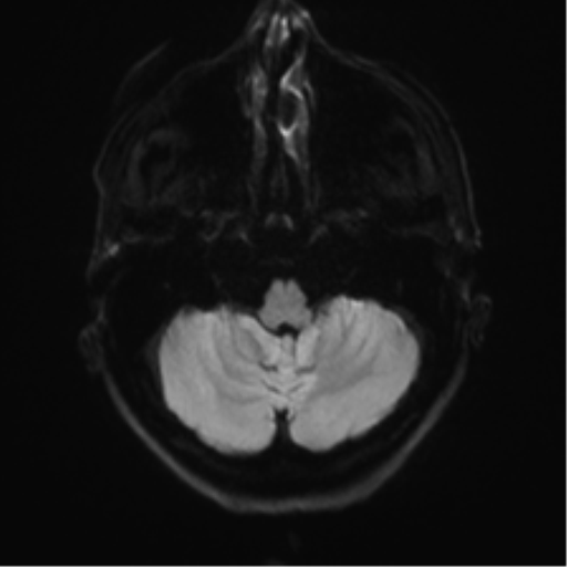 Anaplastic astrocytoma - thalamic glioma (Radiopaedia 59709-67115 Axial DWI 41).png