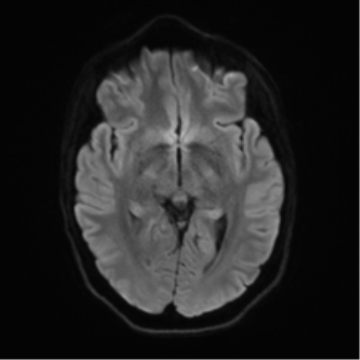 Anaplastic astrocytoma IDH mutant (Radiopaedia 50046-55341 Axial DWI 40).png